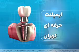 ایمپلنت حرفه‌ای تهران