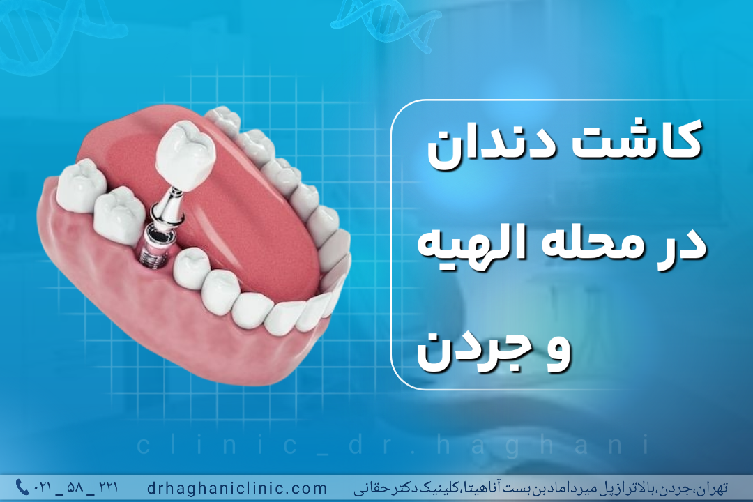 کاشت دندان در محله الهبه و جردن