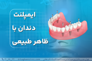 ایمپلنت دندان با ظاهر طبیعی