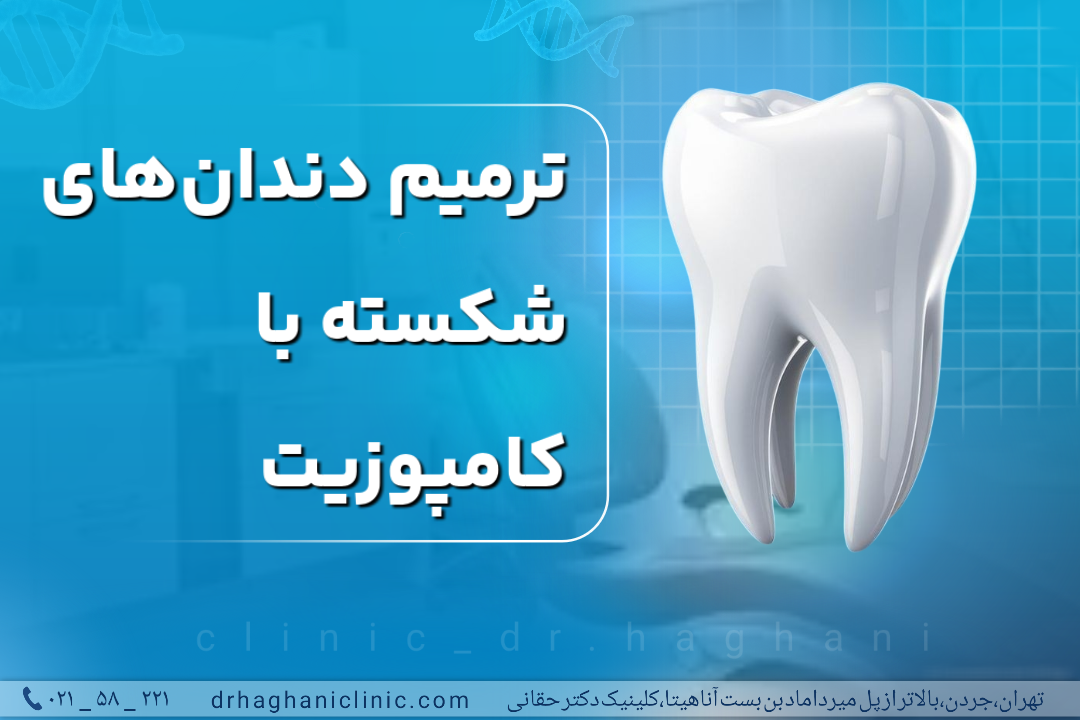 ترمیم دندان‌های شکسته با کامپوزیت