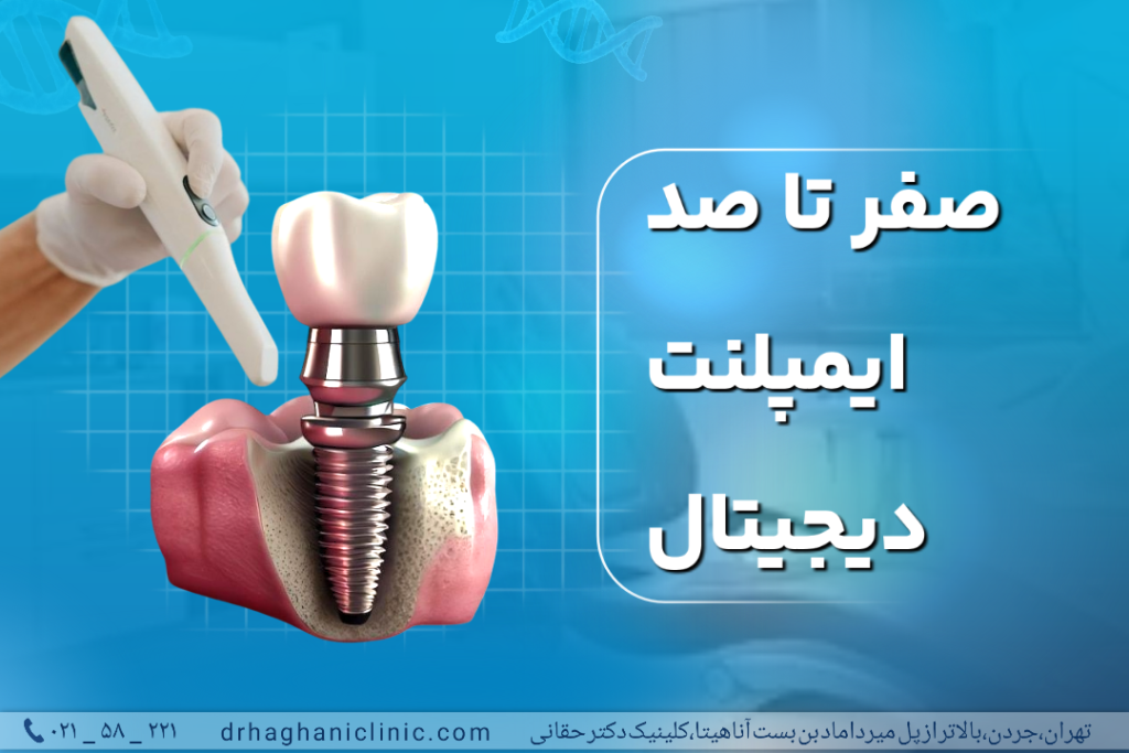 صفر تا صد ایمپلنت دیجیتال