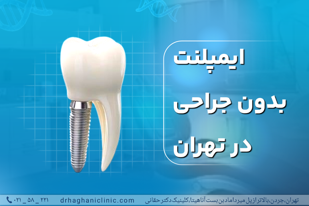 ایمپلنت بدون جراحی در تهران