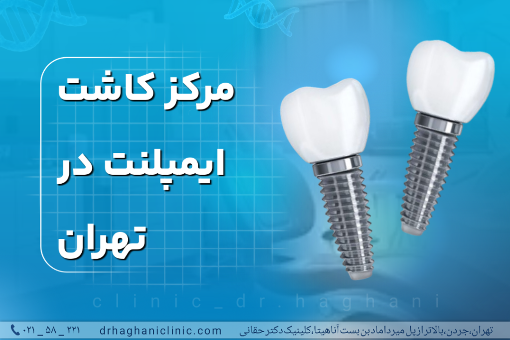 مرکز کاشت ایمپلنت در تهران