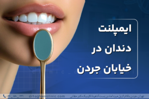 ایمپلنت دندان در خیابان جردن