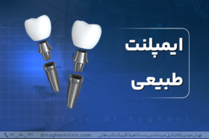 ایمپلنت طبیعی