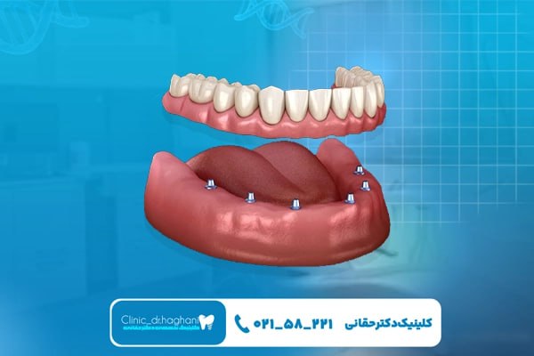 ایمپلنت دندان فک پایین در مرکز دندانپزشکی دکتر حقانی ایمپلنت دندان فک پایین در مرکز دندانپزشکی دکتر حقانی
