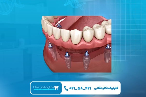  کاشت ایمپلنت دندان در کلینیک دندانپزشکی دکتر حقانی