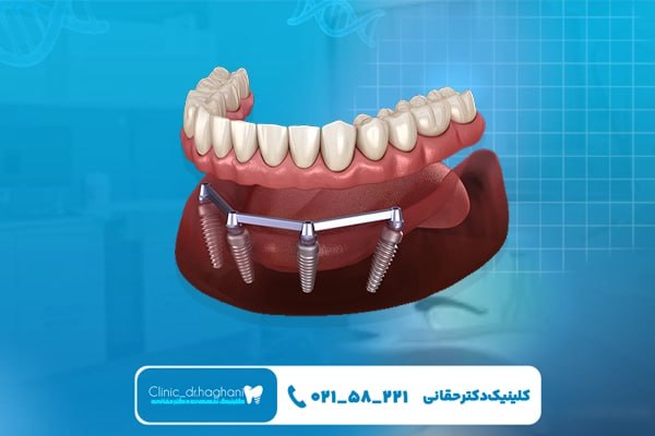 کلینیک تخصصی ایمپلنت کلینیک تخصصی ایمپلنت