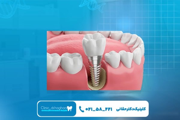خدمات مرکز تخصصی ایمپلنت دندان در کلینیک دندانپزشکی دکتر حقانی