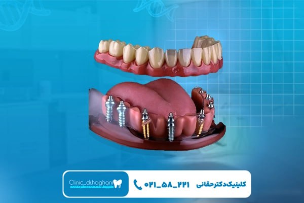 هزینه ایمپلنت با کیفیت بالا در تهران