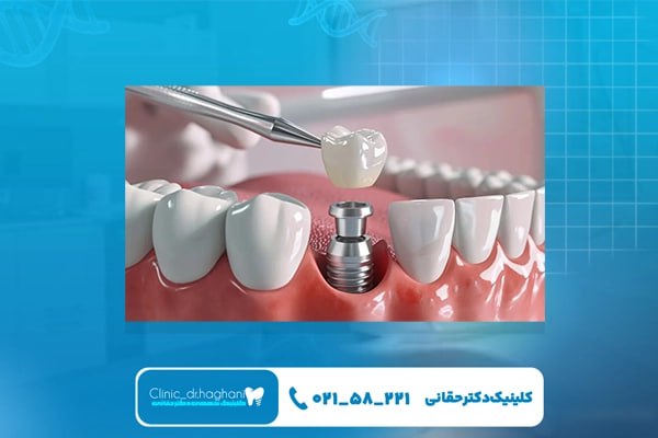 کاشت دندان با روش جدید در مرکز دندانپزشکی دکتر حقانی