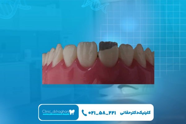 ترمیم دندان‌های شکسته با کامپوزیت