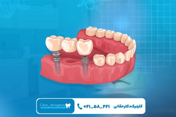 دندان مصنوعی یا پروتز متحرک دندان مصنوعی یا پروتز متحرک
