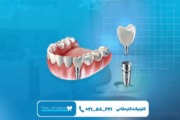کاشت سریع دندان در کلینیک تمام دیجیتال ایمپلنت در تهران 
