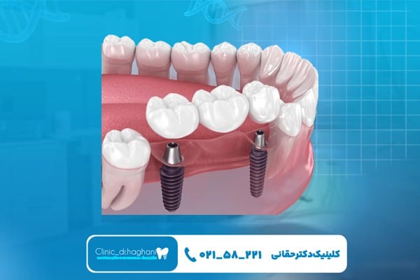 کاشت دندان در جردن در مرکز دندانپزشکی دکتر حقانی کاشت دندان در جردن در مرکز دندانپزشکی دکتر حقانی