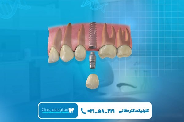 مزیتهای انتخاب مرکز دکتر حقانی برای ایمپلنت مزیتهای انتخاب مرکز دکتر حقانی برای ایمپلنت