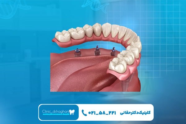 دندانپزشکی دیجیتال ایمپلنت در جردن