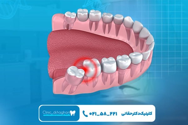 مراحل مختلف کاشت ایمپلنت دندان