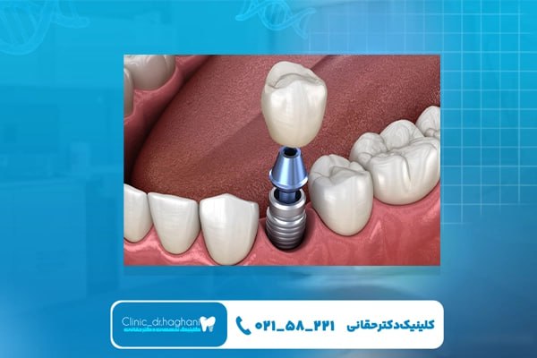 ایمپلنت تخصصی تهران ایمپلنت تخصصی تهران
