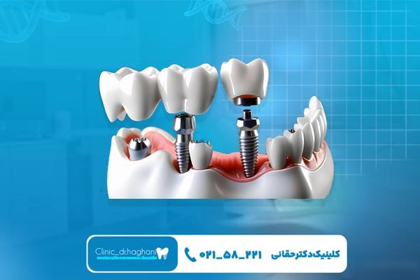 مزایای ایمپلنت‌ دندان در خیابان جردن و در کلینیک دندانپزشکی دکتر حقانی