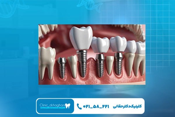 خدمات ایمپلنت در منطقه 3 تهران