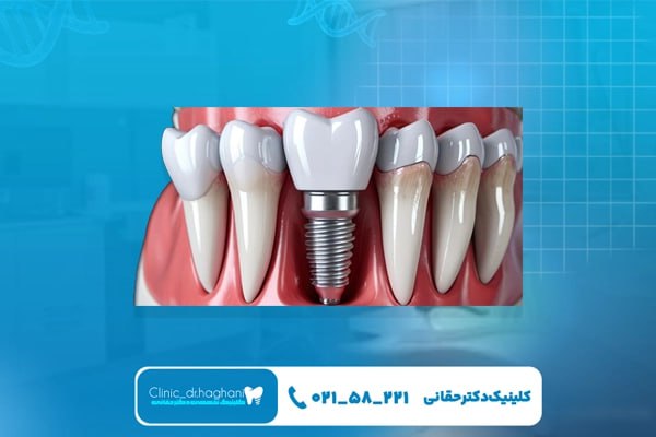 کاشت دندان در محله الهبه و جردن