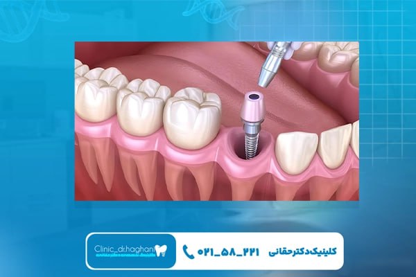 ر قیمت ایمپلنت دندان