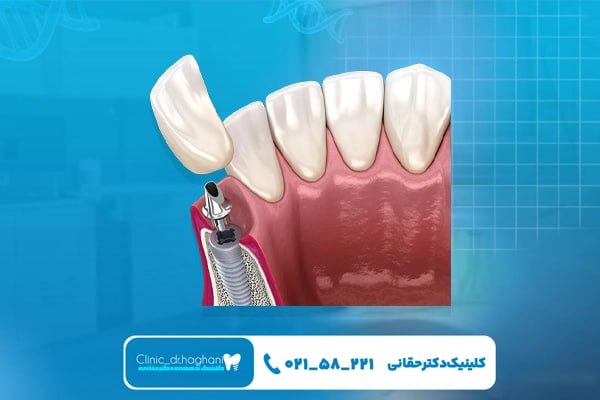 ایمپلنت در کلینیک دندانپزشکی دکتر حقانی برای کسانی که دنبال کیفیت و قیمت مناسب هستند