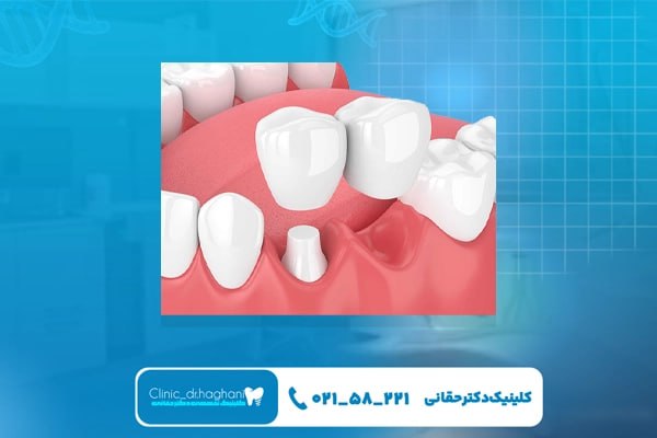 خدمات دندانپزشکی تخصصی در کلینیک دندانپزشکی دکتر حقانی خدمات دندانپزشکی تخصصی در کلینیک دندانپزشکی دکتر حقانی