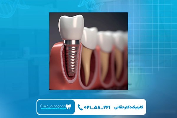 جراح ایمپلنت دندان جراح ایمپلنت دندان