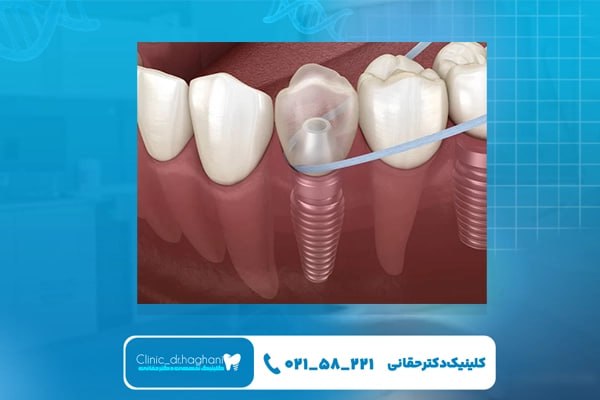 بهترین دکتر ایمپلنت در تهران