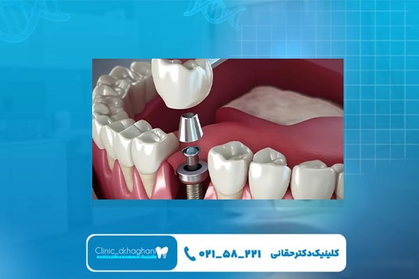 ایمپلنت دندان تحت نظر پزشک متخصص