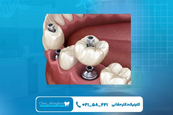 ایمپلنت بدون جراحی در تهران