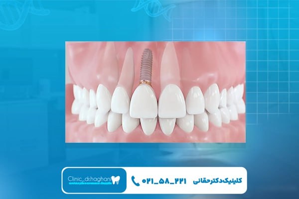 ایمپلنت دندان سریع ایمپلنت دندان سریع