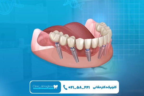 کلینیک تخصصی کاشت دندان در تهران