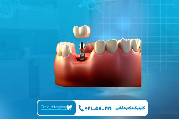 کلینیک تخصصی کاشت دندان در تهران