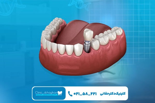 کلینیک تخصصی کاشت دندان در تهران