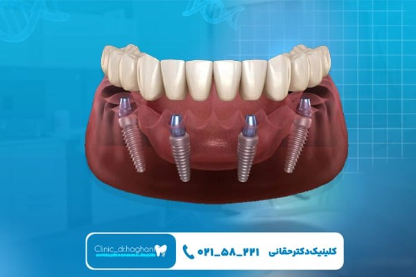 ایمپلنت دندان فک پایین ایمپلنت دندان فک پایین