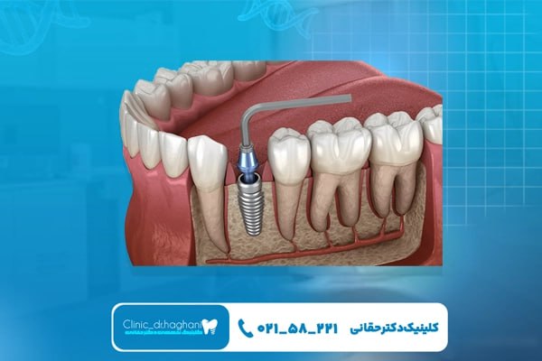 فرایند انجام ایمپلنت دندان به صورت تخصصی