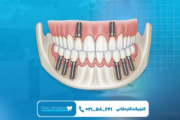 مراحل انجام ایمپلنت دندان