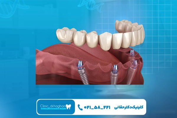 شیوه‌های جراحی در مرکز تخصصی ایمپلنت