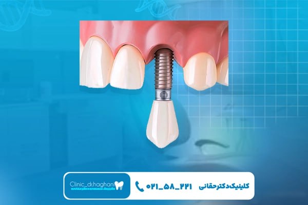 خدمات تخصصی ایمپلنت دندان در مرکز دندانپزشکی دکتر حقانی