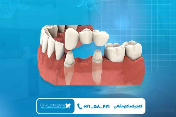  ترمیم دندان با دندانپزشکی مجهز و دیجیتال