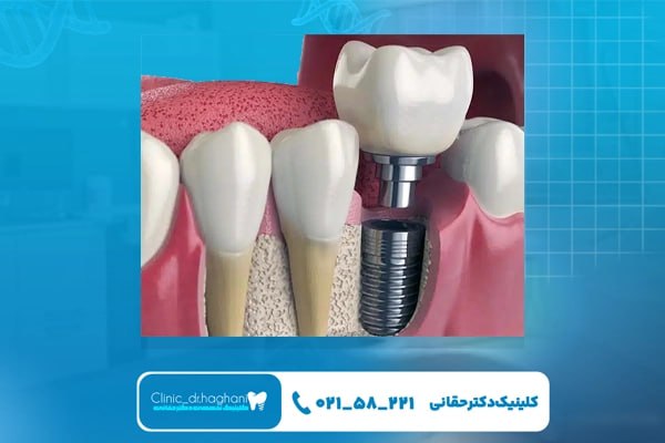 شیوه اجرای روش جدید کاشت دندان بدون جراحی
