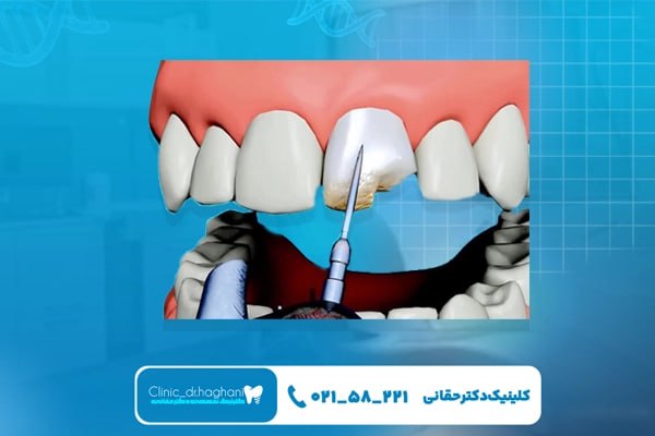 شیوه انجام ترمیم دندان‌های شکسته با کامپوزیت