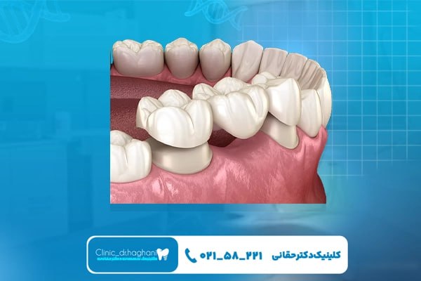 کاشت دندان درتهران کاشت دندان درتهران