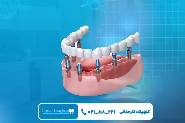 فرق ایمپلنت دیجیتال با شیوه سنتی از نظر دقت و سرعت