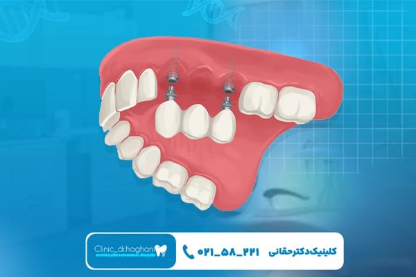 مزیتهای کاشت دندان مزیتهای کاشت دندان