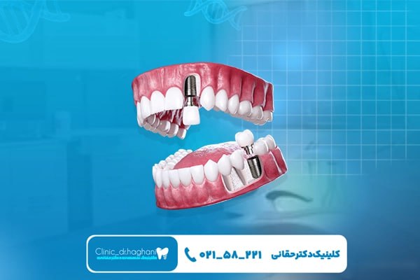 چه اشخاصی نمیتوانند ایمپلنت دندان انجام دهند چه اشخاصی نمیتوانند ایمپلنت دندان انجام دهند