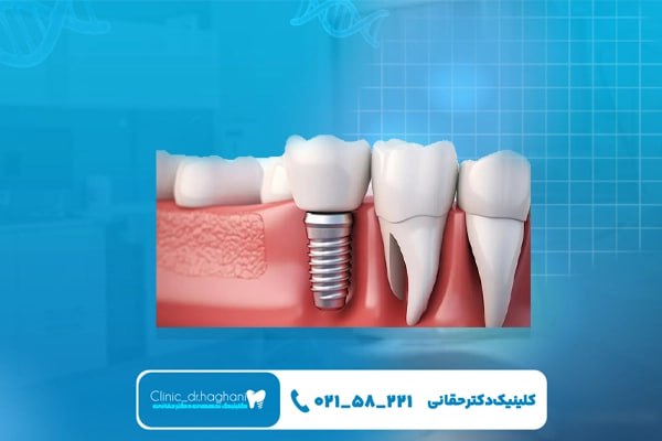 مراحل جراحی ایمپلنت دندان 